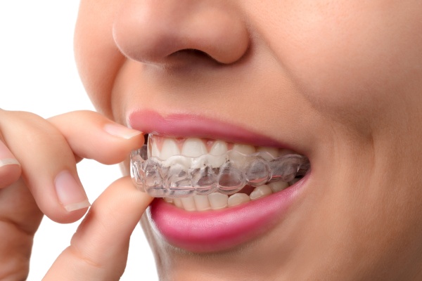 Unveiling the Wonders of Invisalign for a Confident Smile Makeover