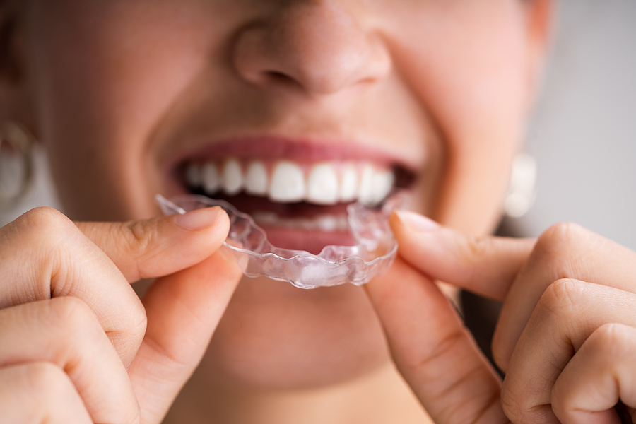 How to achieve a straighter, beautiful smile with Invisalign?