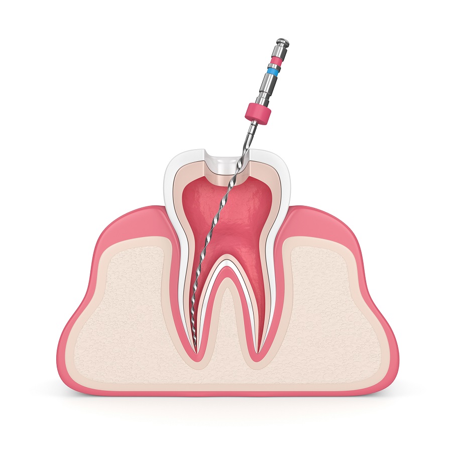 What is a Root Canal?