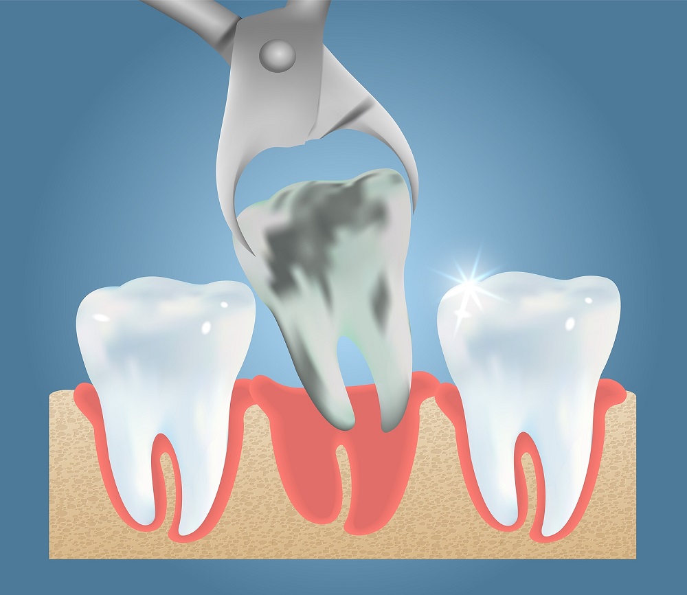 Will You Need a Dental extraction?