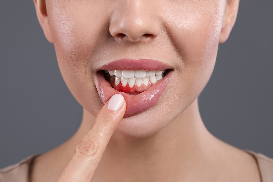 4 Common Symptoms of Gum Disease